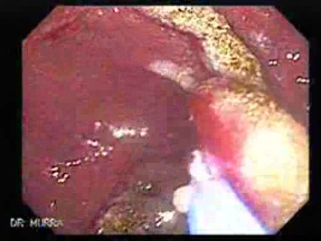 Multiple Adenomatous Polyps Of The Rectum (12 of 37)