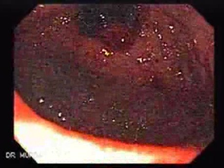 Placement Of The Esophageal Stent - 8/12