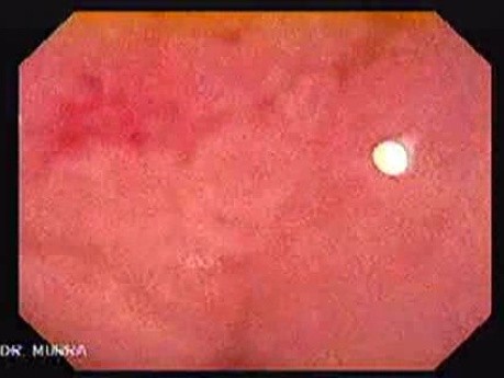 Rectal Adenocarcinoma (4 of 12)