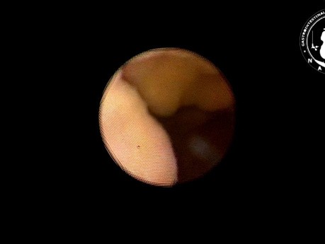 Choledochoscopy and Common Bile Duct Exploration
