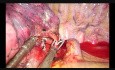 Unisurgeon Uniportal VATS Anatomic S1 with Magnetic Grasper