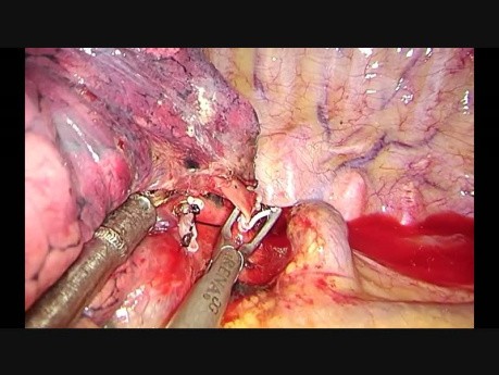 Unisurgeon Uniportal VATS Anatomic S1 with Magnetic Grasper