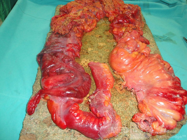 Multiple Rectal Ulcers (71 of 110)