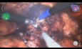 Robotic Assisted Radical Prostatectomy (RARP) with Versius - Maurizio De Maria