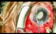 Dislocated IOL Exchange with Yamane Fixation, Part 2