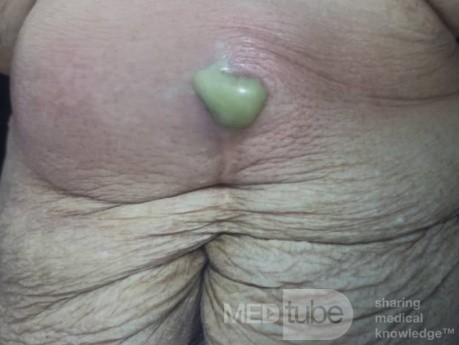 Abdominal Wall Abscess