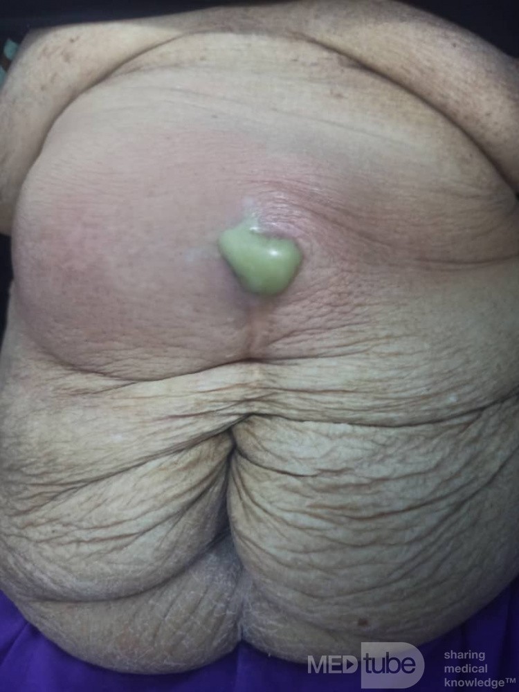 Abdominal Wall Abscess