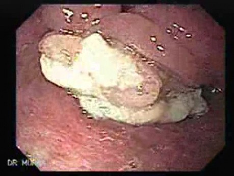 Esophageal Squamous Cell Carcinoma of the the Upper Third of the Esophagus that Invaded the Subglottis - Appearance of the Neoplasia