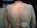 Extensive Acanthosis Nigricans due to rectal carcinoma (5 of 7)