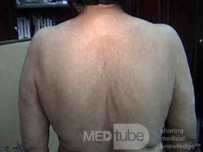 Extensive Acanthosis Nigricans due to rectal carcinoma (5 of 7)
