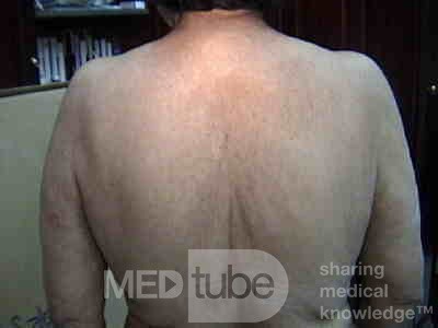 Extensive Acanthosis Nigricans due to rectal carcinoma (5 of 7)