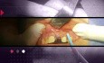 Fresh Socket Implant Placement