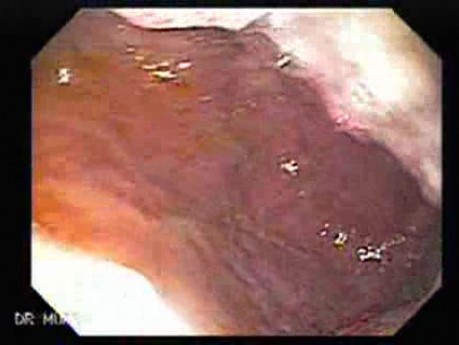 Gastric Adenocarcinoma With Varices - Endoscopy (8 of 8)