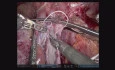 Robotic Deceased Donor Liver Transplant