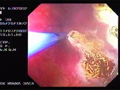 Evolution of a Gastric Carcinoma without a Treatment (10 of 10)