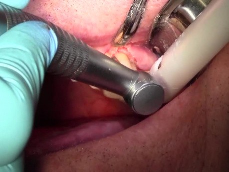 Clinical Crown Lengthening #14