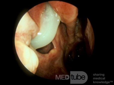 Inferior Meatal Antrostomy [right]
