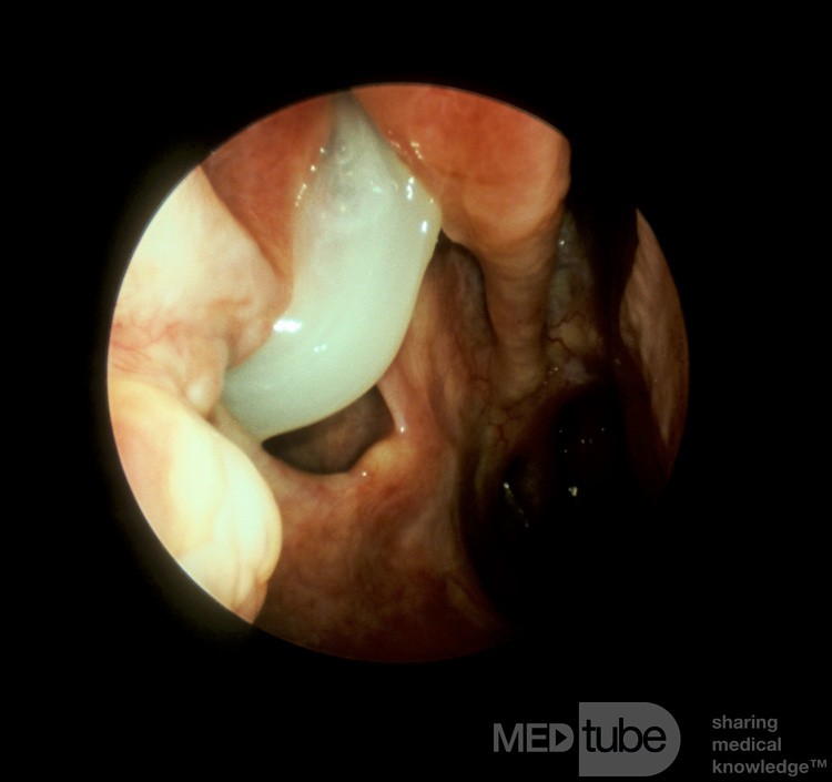 Inferior Meatal Antrostomy [right]