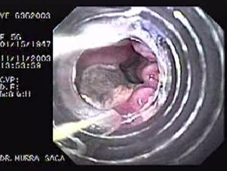 Endoscopic Variceal Ligation - 56 Years-Old Female
