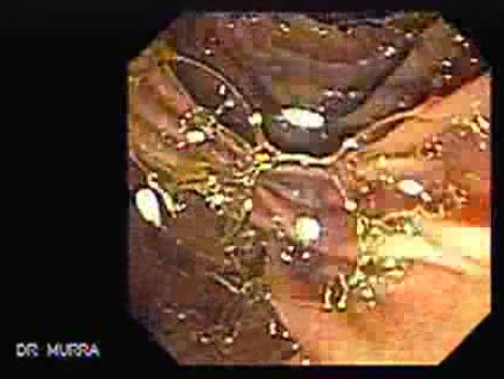 Adenocarcinoma of Papilla of Vater (2 of 5)