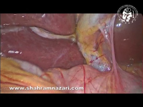 The Anatomy of Rouviere's Sulcus as Seen During Laparoscopic Cholecystectomy