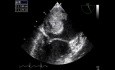 Myxoma In Cardiac Echo
