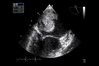 Myxoma In Cardiac Echo