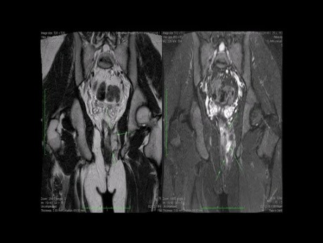 Inappropriate Use of Laser Treatment for Piles and Fistula Can be Life Threatening
