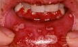 Herpetic Gingivostomatitis