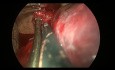 Uniportal VATS Resection of Complex Huge Bronchogenic Cyst