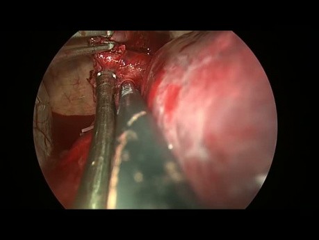 Uniportal VATS Resection of Complex Huge Bronchogenic Cyst