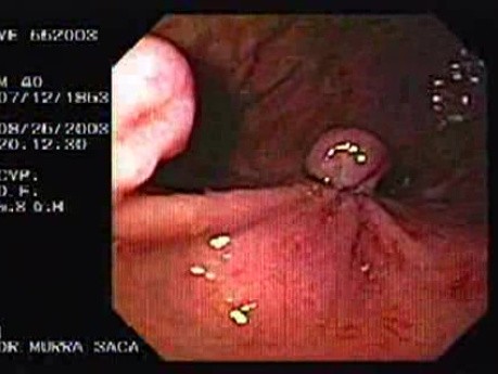 Acute Variceal Bleeding - Ligated Varix at the Gastric Fundus