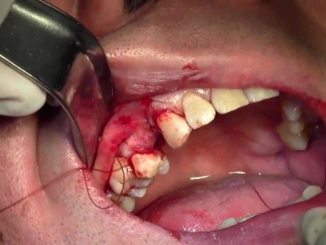 Suturing Technique - Implant Placement #5