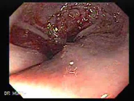 Adenocarcinoma of the cardias (7 of 14)