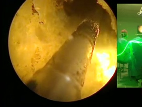 Green Light Laser Surgery for Prostate Enlargement 