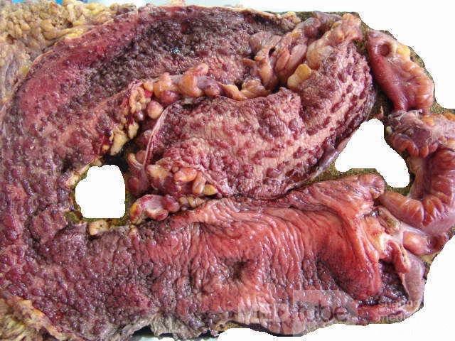 Multiple Rectal Ulcers (99 of 110)