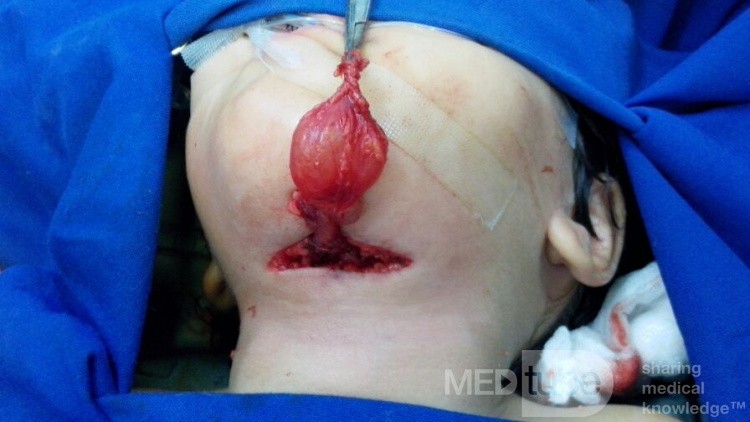 Thyroglossal Cyst 