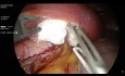 Sleeve Gastrectomy
