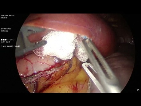 Sleeve Gastrectomy