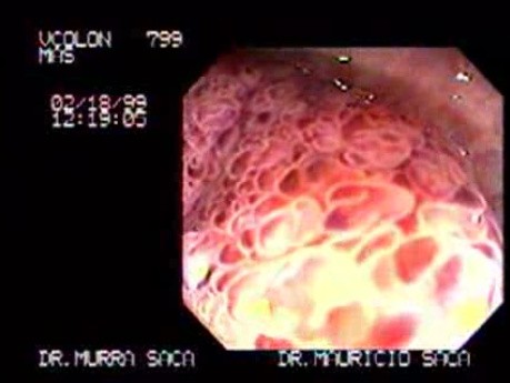 Villous Adenoma