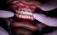 Interproximal Reduction - Ortho Update - Explanation Of Case