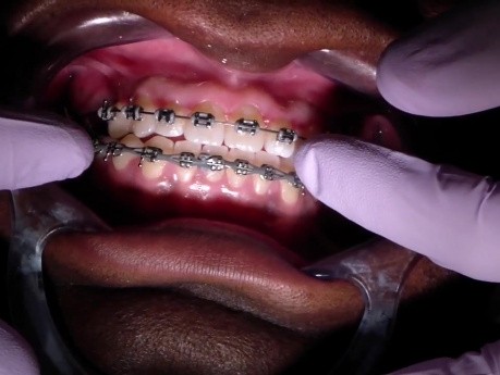 Interproximal Reduction - Ortho Update - Explanation Of Case