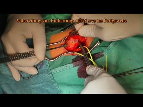 Ulnar Sulcus Syndrome