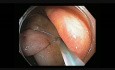Colonoscopy Channel Quiz 2