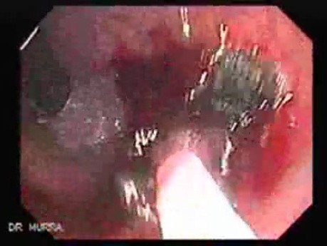 Endoscopic Resection of Giant Tubulo-Villous of the rectum (12 of 35)