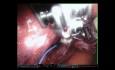 Segmentectomy S9 + S10