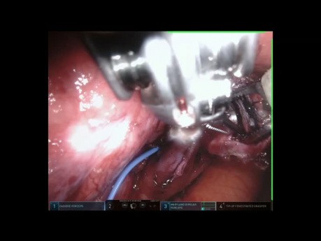 Segmentectomy S9 + S10