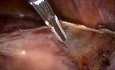 20 weeks Size Fibroid