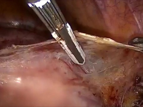 20 weeks Size Fibroid