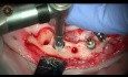 Dental Implant Extraction and Immediate Implants Insertion Combined with GBR